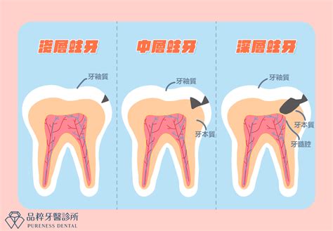 門牙一大一小|當牙齒發生蛀洞狀況時，代表蛀牙已經蔓延到象牙質。